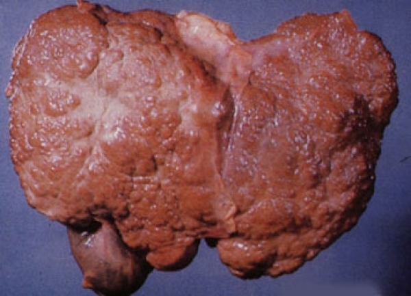 imagine cu ciroza hepatica